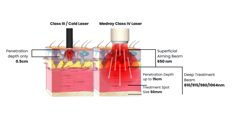 Top 4 Biological Effects of Class IV Laser Therapy That You Should Know